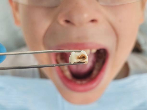 Best Same-Day Emergency Dentist in Ashburn, GA